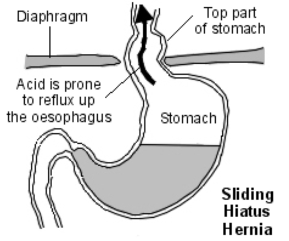 Sliding Hiatus Hernia diagram